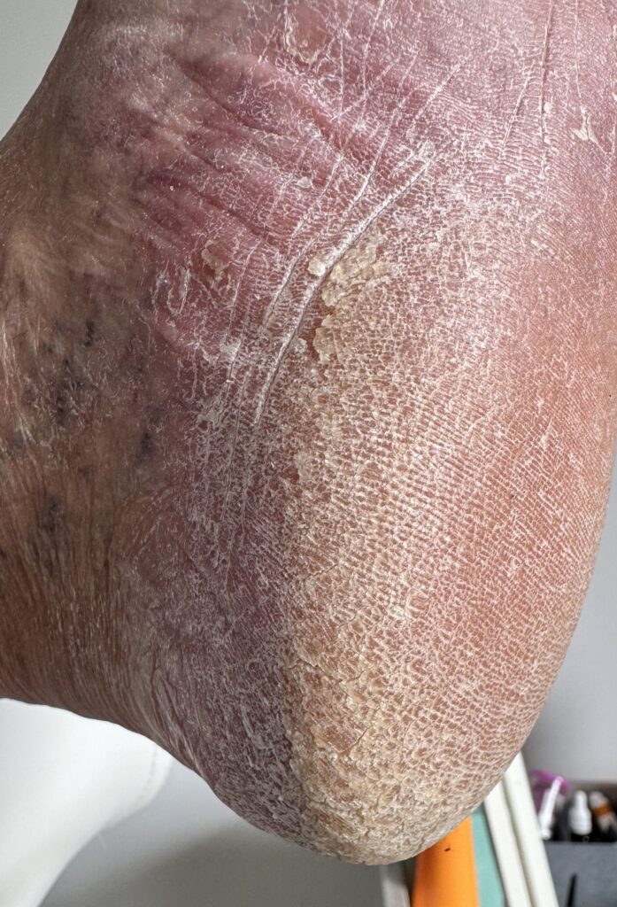 pielęgnacja stóp u diabetyków