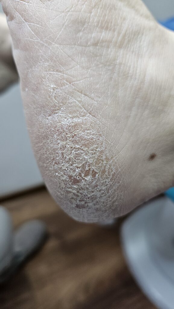 stopy zniszczone przez niewłaściwe używanie skarpetek złuszczajacych