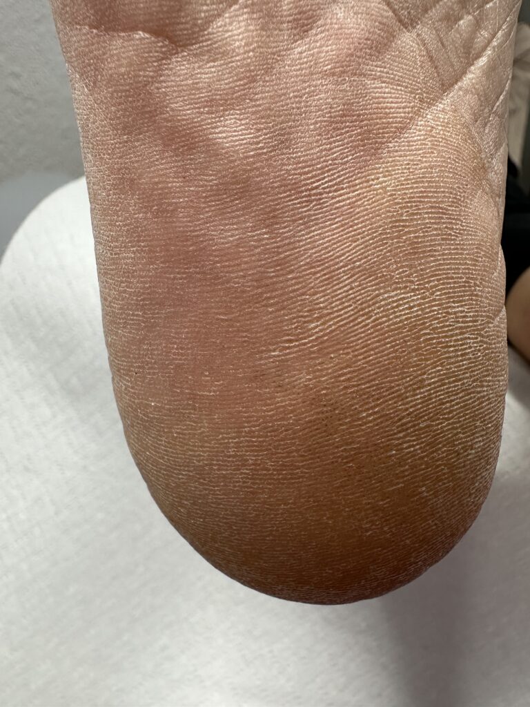 stopa sportowca przed zabiegiem