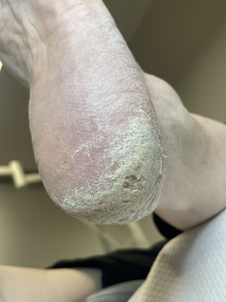 stopa starszej osoby przed zabiegiem podologicznym