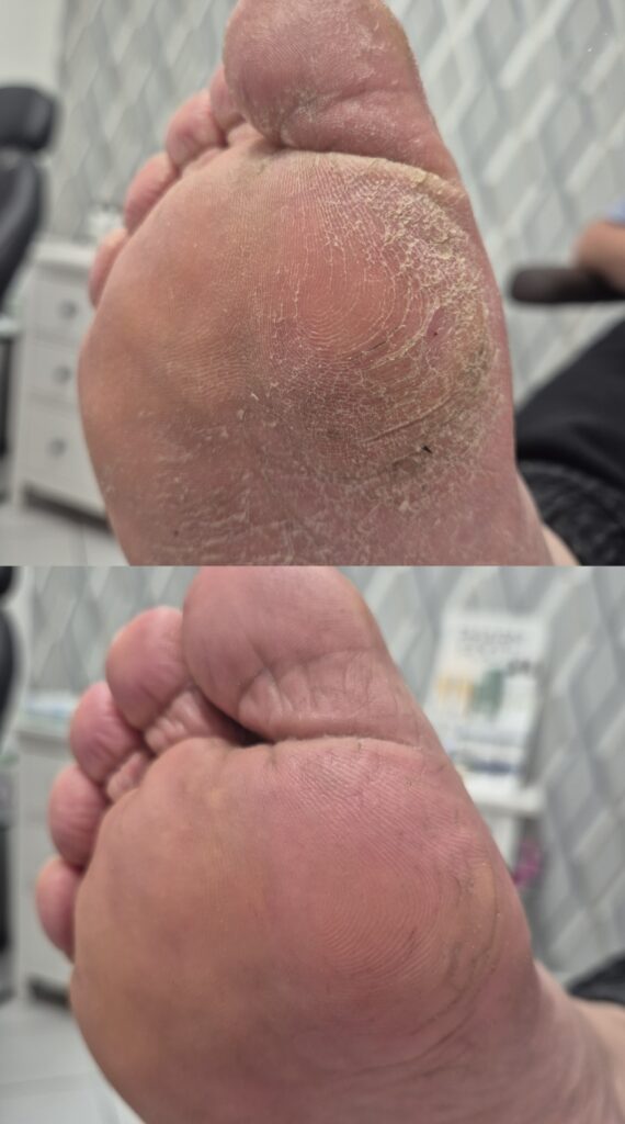 porównanie przed i po Pedi Pro