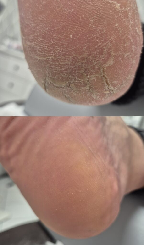 Przed i po - case study Pedi Pro