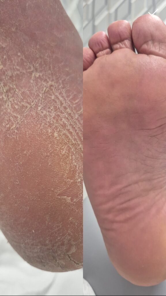 zestawienie przed i po zabiegu Pedi Pro